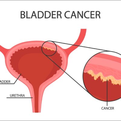 5 Early Warning Signs of Bladder Cancer
