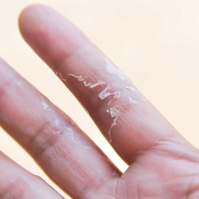 Top 5 Hypoallergenic Detergents for Sensitive Skin