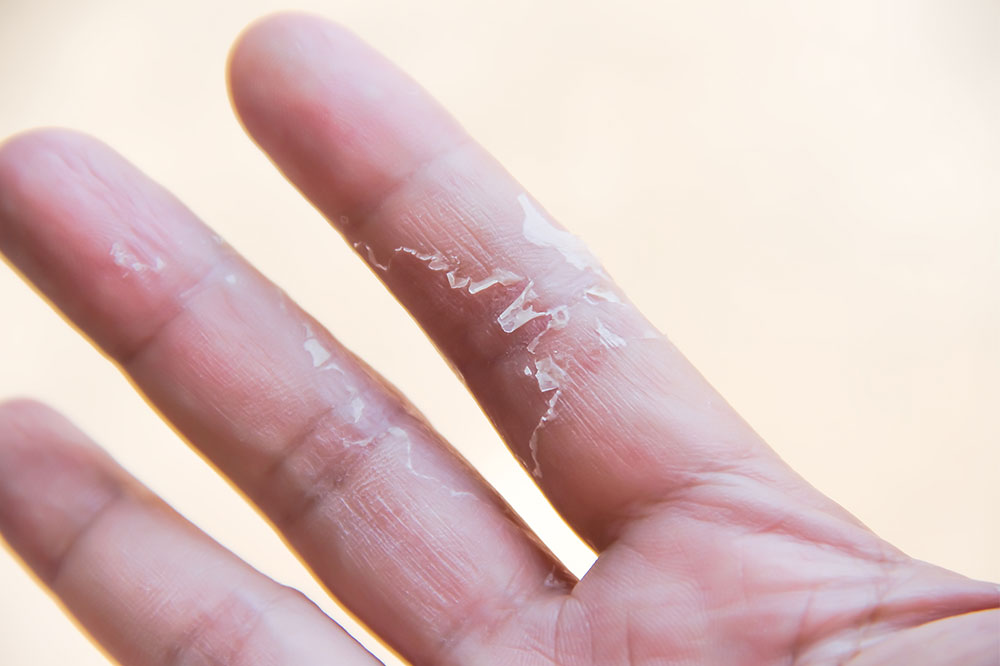 Top 5 Hypoallergenic Detergents for Sensitive Skin