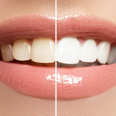 Top 5 Teeth Whitening Toothpastes