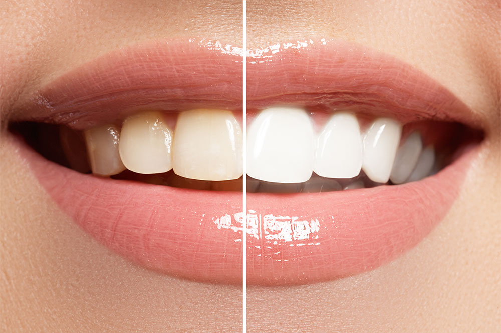 Top 5 Teeth Whitening Toothpastes