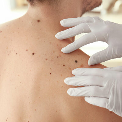 5 Tips to Reduce the Risk of Melanoma