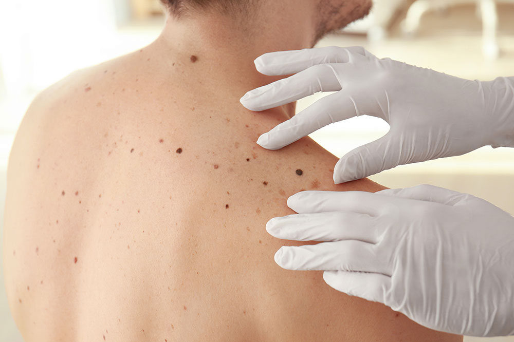 5 Tips to Reduce the Risk of Melanoma