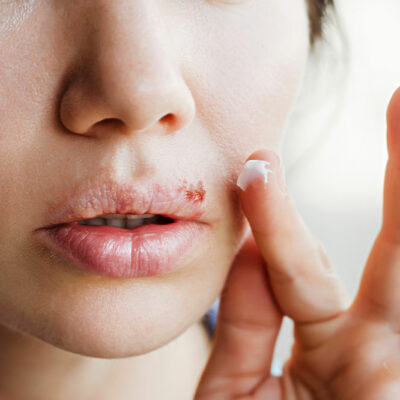 6 Common Triggers of Cold Sores