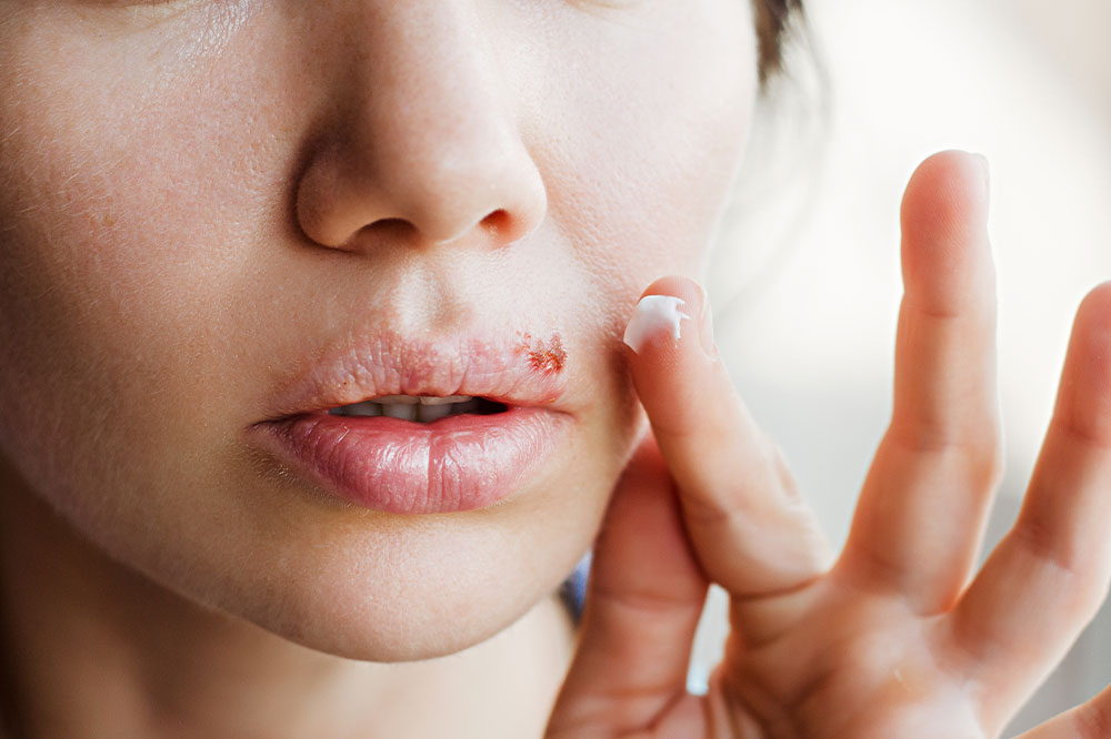 6 Common Triggers of Cold Sores