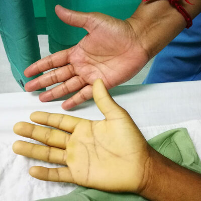 6 Early Warning Signs of Anemia