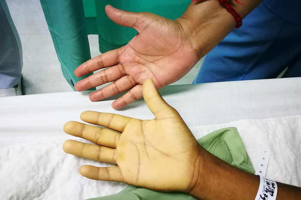 6 Early Warning Signs of Anemia