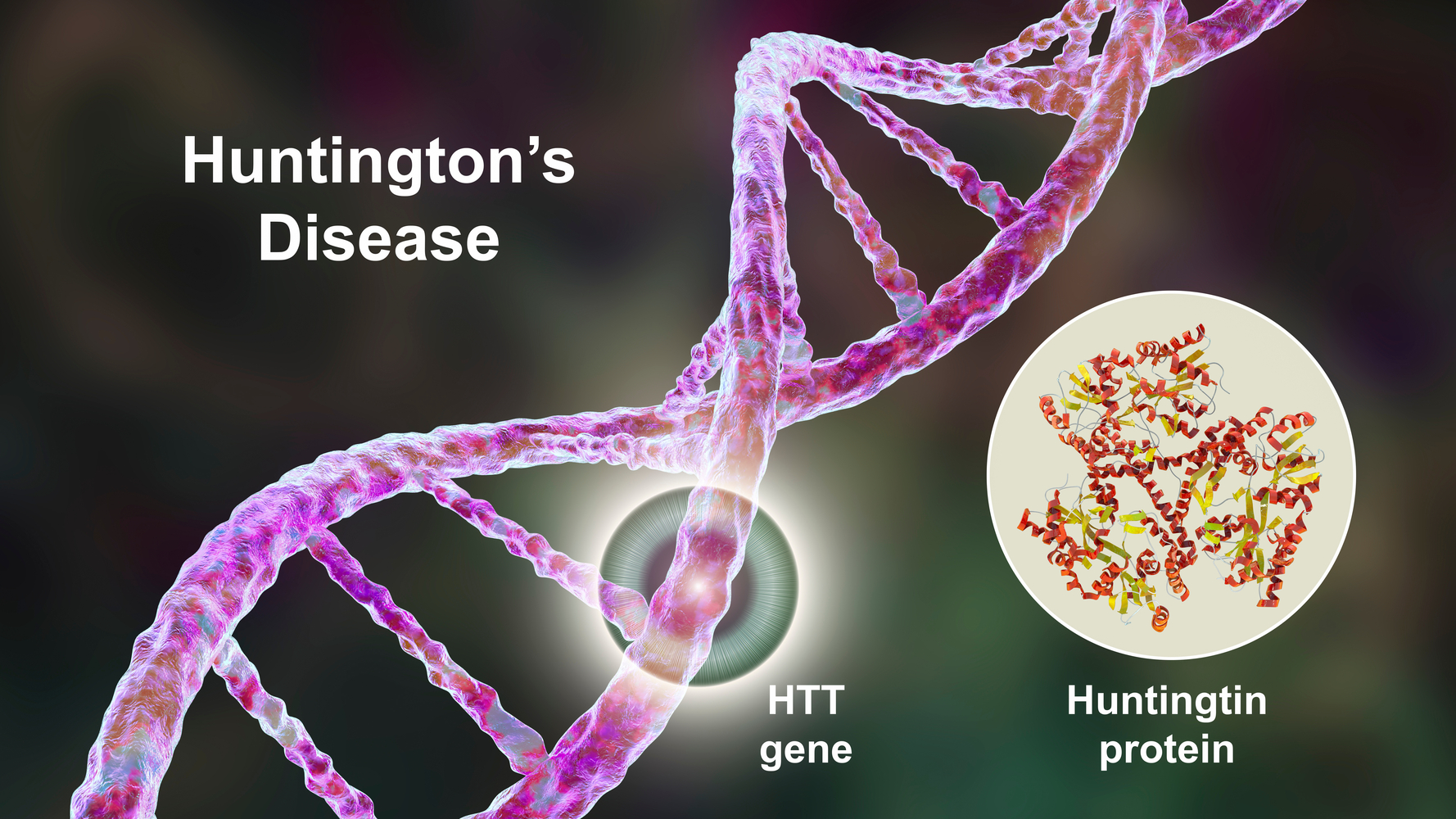 The Primary Cause Of Huntington’s Chorea